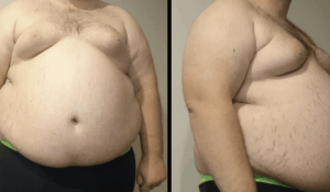 drmyu.com-treatments-Obesity due to fat
